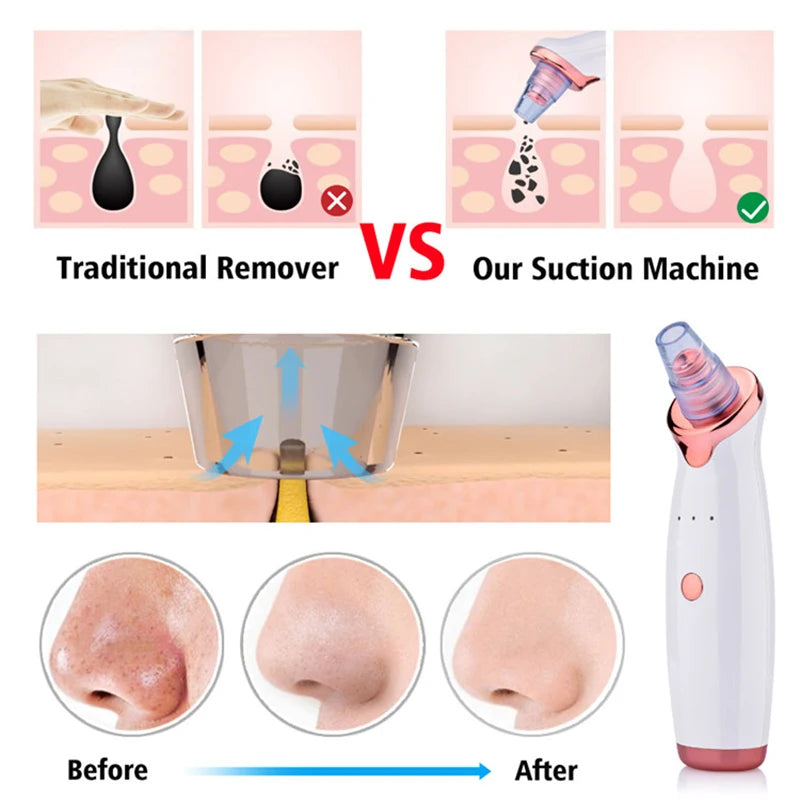 Novalyne Electric Facial Blackhead Remover©