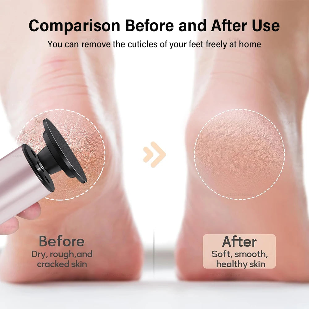 Novalyne Electric Callus Remover©