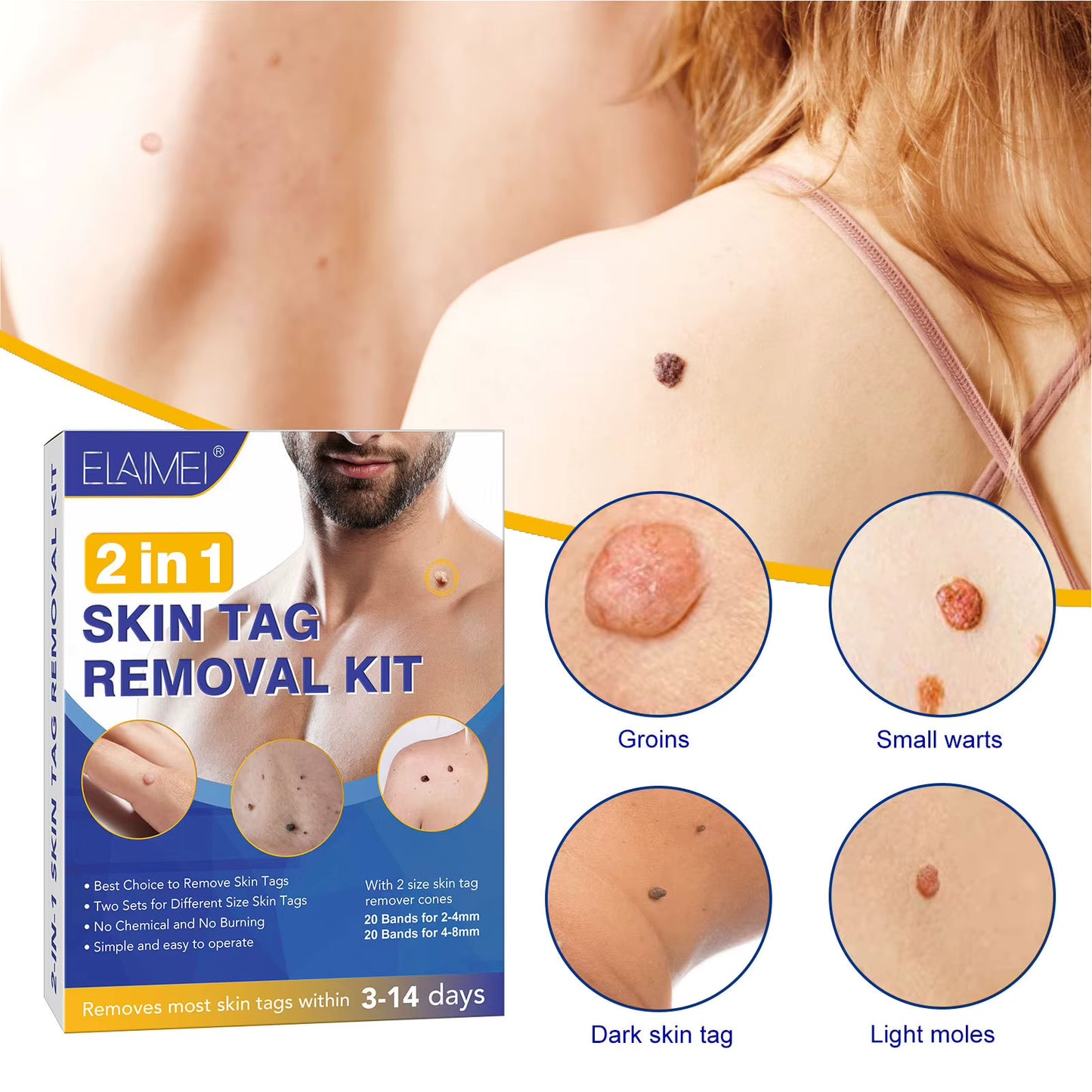 Novalyne Skin Tag Removal Kit©